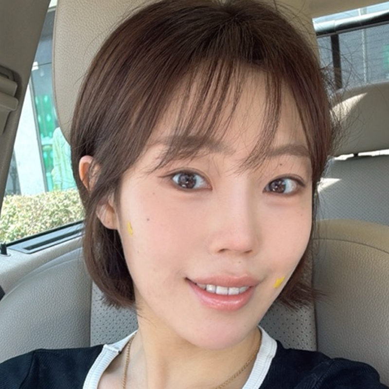 팝성형외과에서 12홀 자연유착+앞트임+윗트임+뒤트임+밑트임 2개월차 후기입니다!