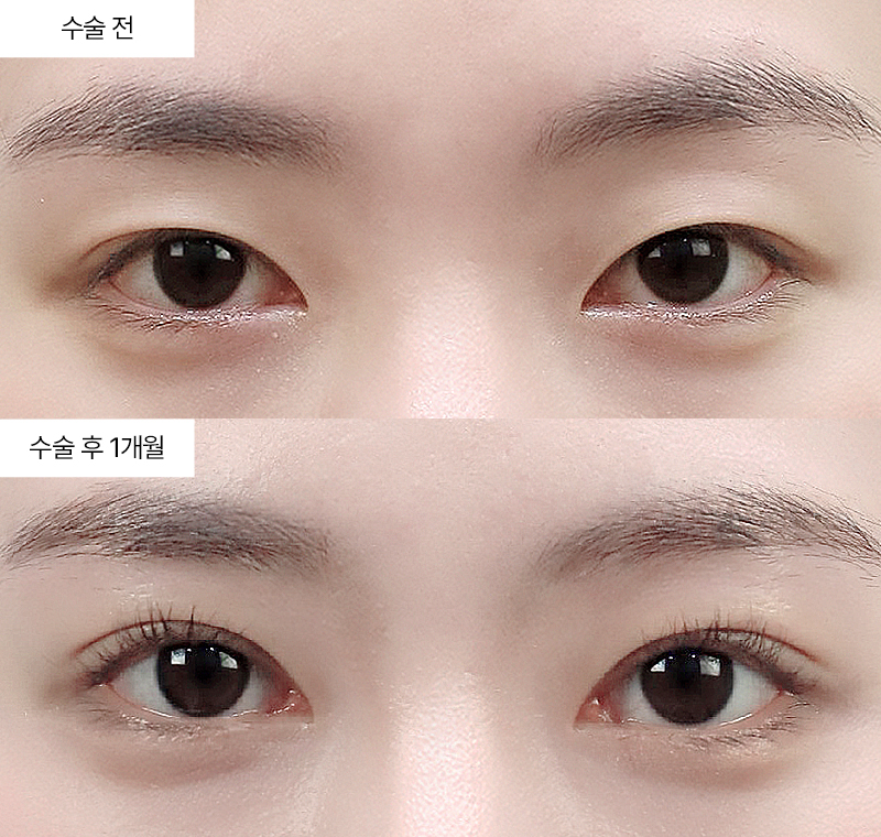 12홀 자연유착 · 압구정 팝성형외과 전후사진