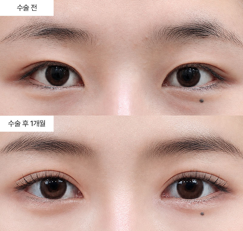12홀 자연유착+앞트임+윗트임 · 압구정 팝성형외과 전후사진