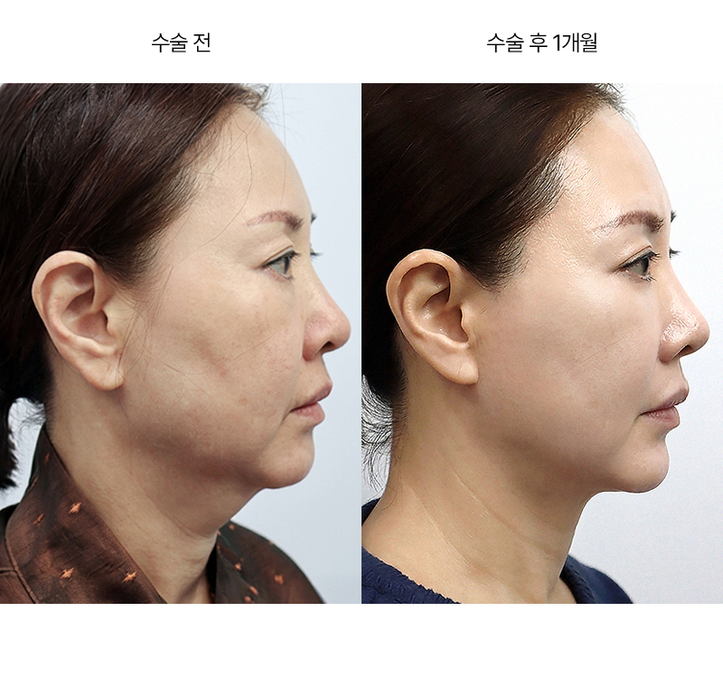 미니거상 · 압구정 팝성형외과 전후사진