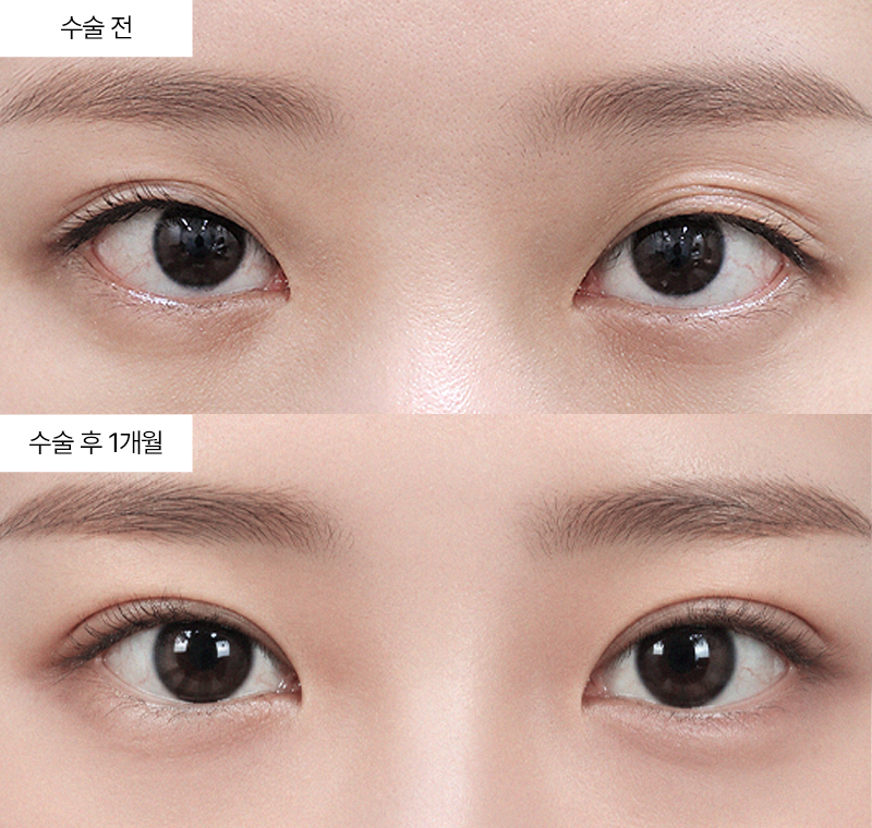 12홀 자연유착+눈매교정