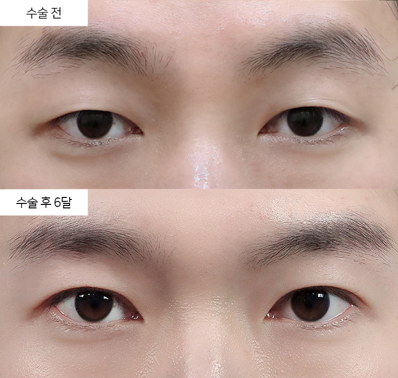 12홀 자연유착 + 눈매교정
