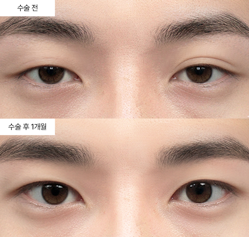 12홀자연유착+눈매교정