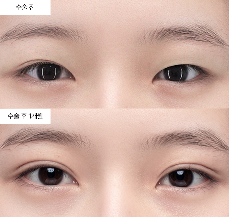 12홀 자연유착+눈매교정+윗트임 · 압구정 팝성형외과 전후사진