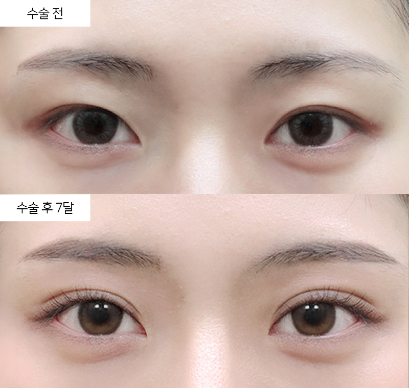 12홀 자연유착 + 윗트임