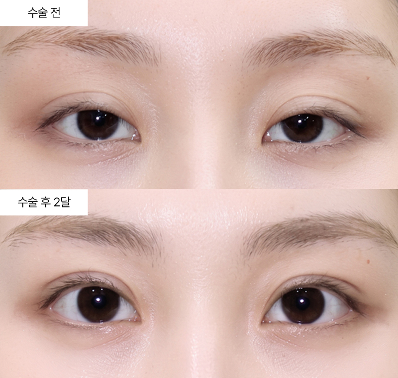 자연유착+윗트임+앞트임+눈매교정 · 압구정 팝성형외과 전후사진