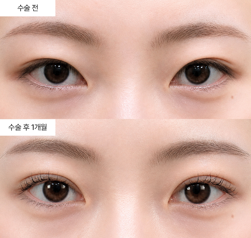 12홀 자연유착+윗트임 · 압구정 팝성형외과 전후사진