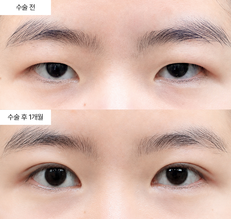 12홀 자연유착+윗트임+앞트임+눈매교정+눈위지방제거 · 압구정 팝성형외과 전후사진