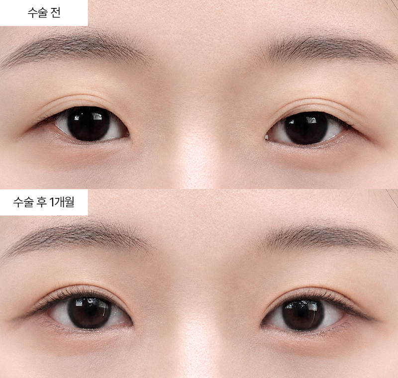 12홀 자연유착+윗트임+앞트임+뒤트임+밑트임