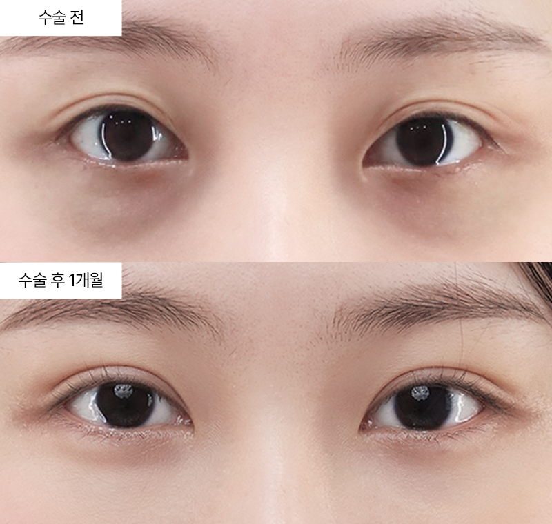 12홀 자연유착+눈매교정+윗트임+눈밑지방재배치