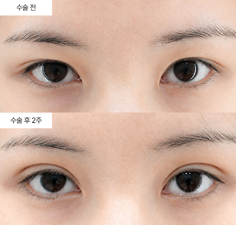 이마거상+12홀 자연유착+윗트임 · 압구정 팝성형외과 전후사진