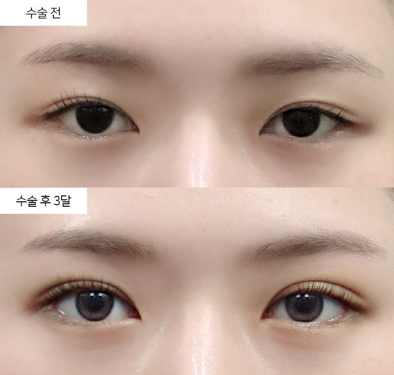 12홀 자연유착 + 뒷트임 + 밑트임