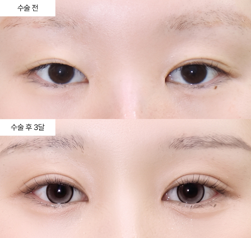 눈재수술+윗트임+앞트임+뒤트임+밑트임 · 압구정 팝성형외과 전후사진