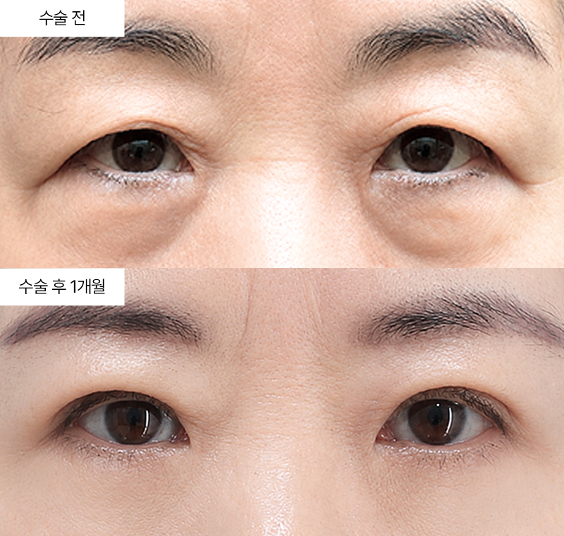 눈썹하거상+12홀 자연유착+하안검 · 압구정 팝성형외과 전후사진