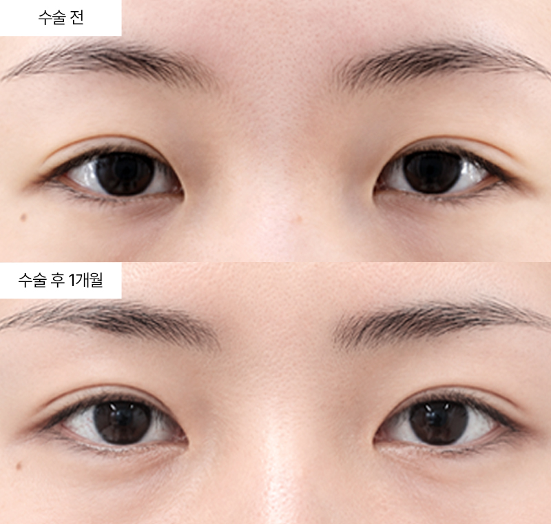 윗트임+앞트임 · 압구정 팝성형외과 전후사진