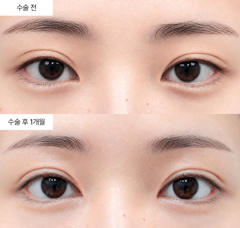 12홀 자연유착+윗트임+앞트임 · 압구정 팝성형외과 전후사진