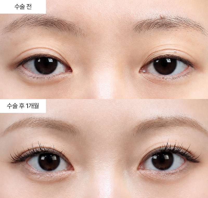 절개+눈위지방재배치 · 압구정 팝성형외과 전후사진