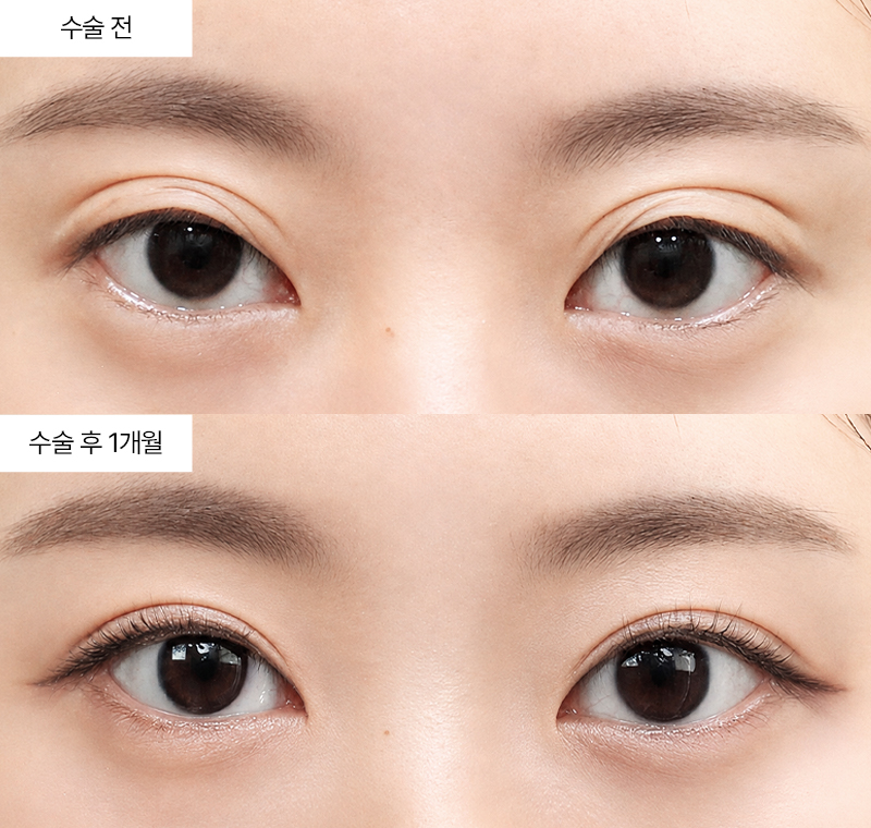 두줄따기+눈위지방재배치+눈매교정 · 압구정 팝성형외과 전후사진