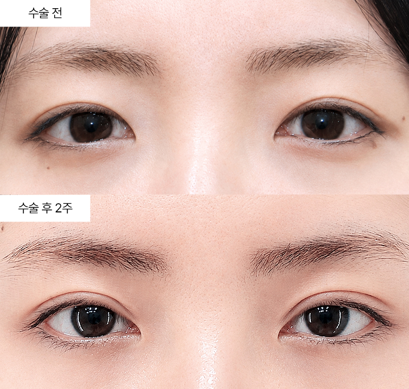 12홀 자연유착+눈매교정+윗트임 · 압구정 팝성형외과 전후사진