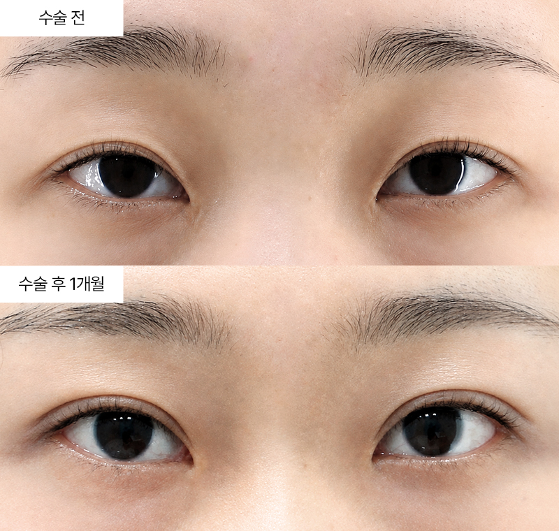 12홀 자연유착+눈매교정+윗트임