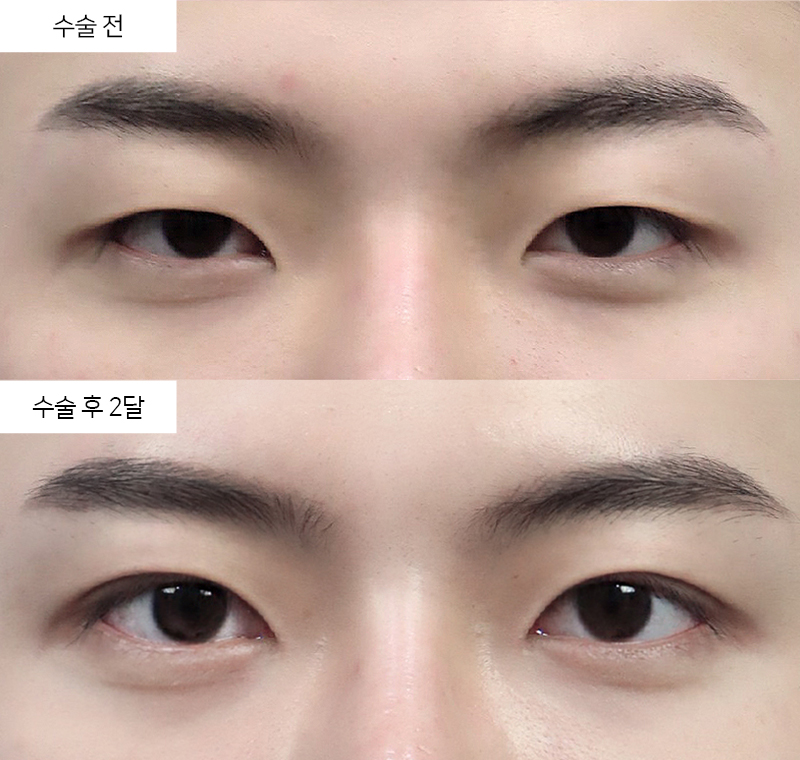 12홀 자연유착 + 눈매교정 + 앞트임