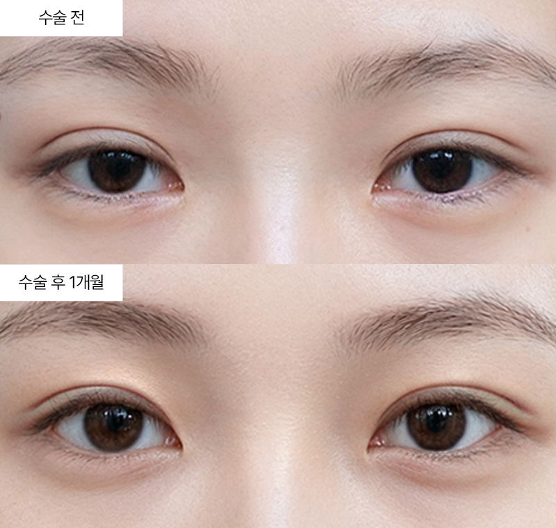 두줄따기