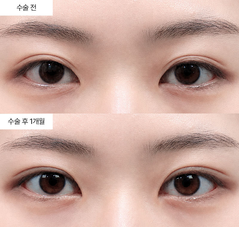 12홀 자연유착 · 압구정 팝성형외과 전후사진