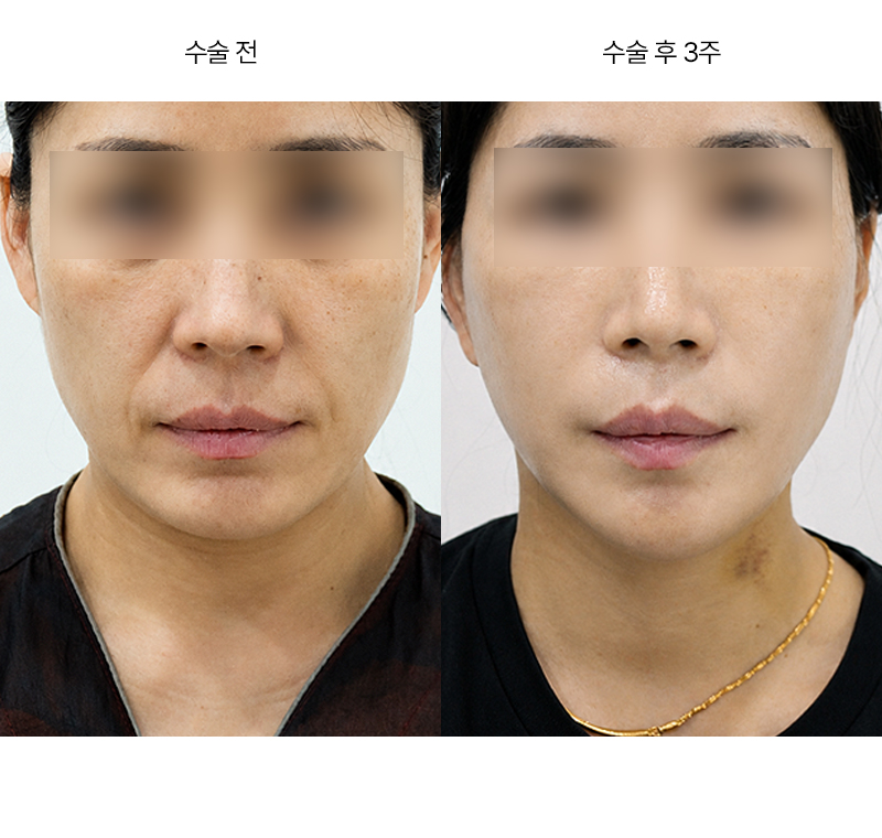 미니거상 · 압구정 팝성형외과 전후사진