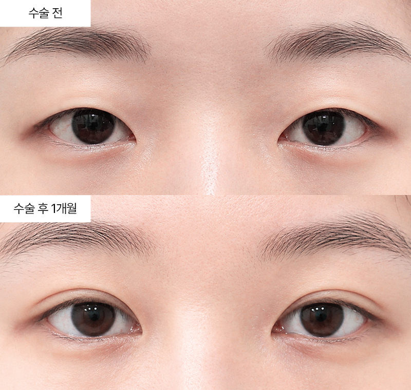 12홀 자연유착+눈매교정+윗트임+앞트임