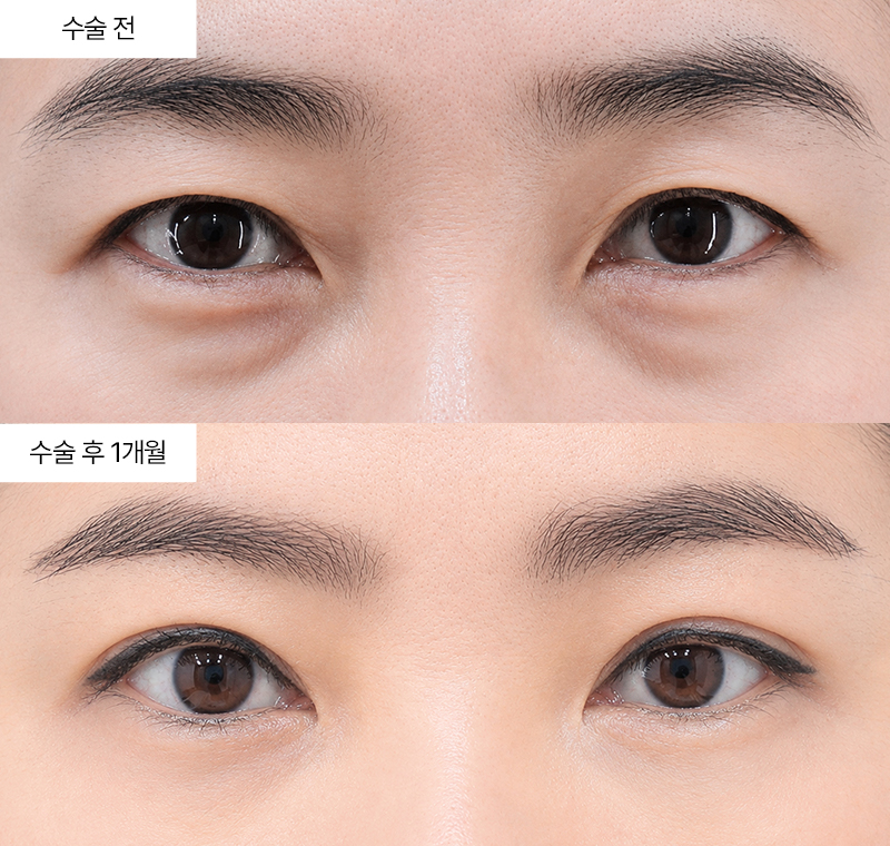 눈썹하거상+12홀 자연유착+눈밑지방재배치 · 압구정 팝성형외과 전후사진