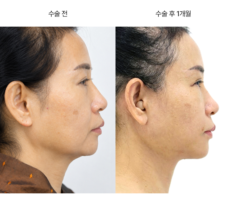 안면거상+목거상+이중턱근육묶기+하안검