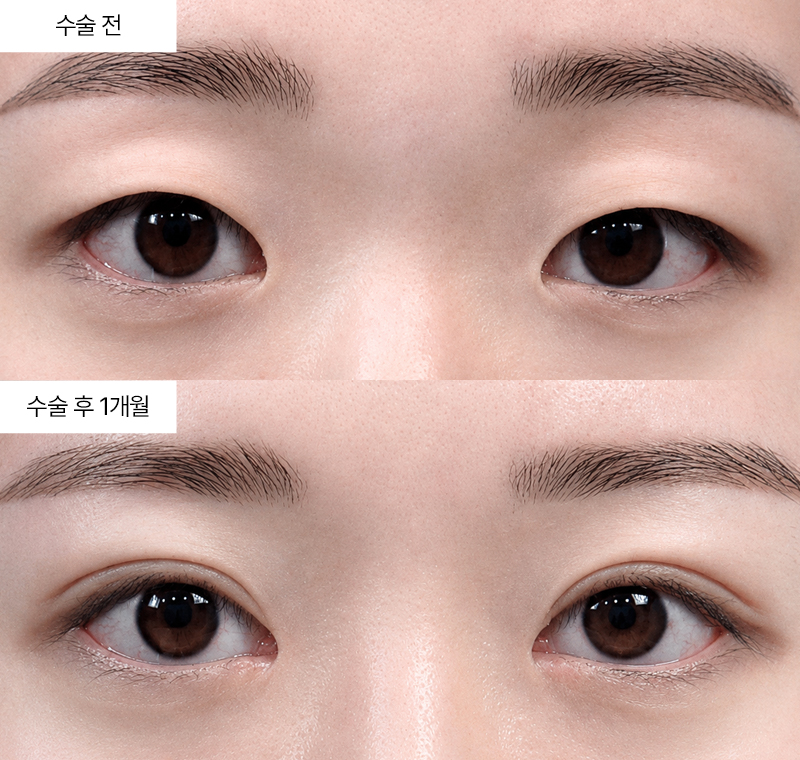 12홀 자연유착+윗트임+앞트임 · 압구정 팝성형외과 전후사진