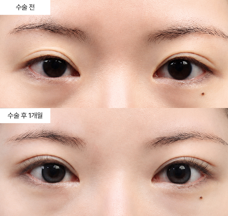 12홀 자연유착+눈매교정+윗트임+밑트임 · 압구정 팝성형외과 전후사진
