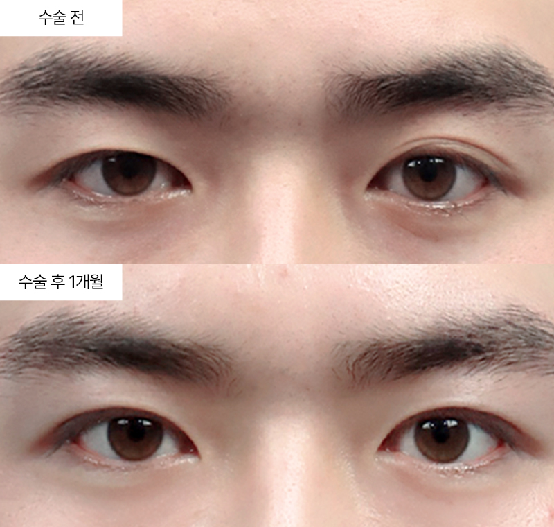 12홀자연유착+눈매교정