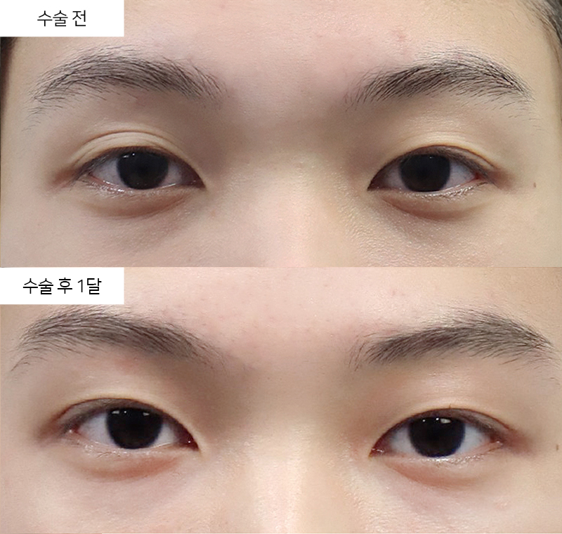12홀 자연유착 + 눈매교정