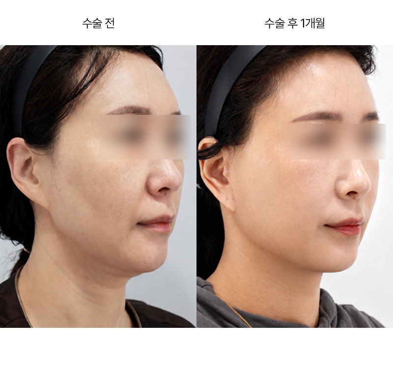 미니거상 · 압구정 팝성형외과 전후사진