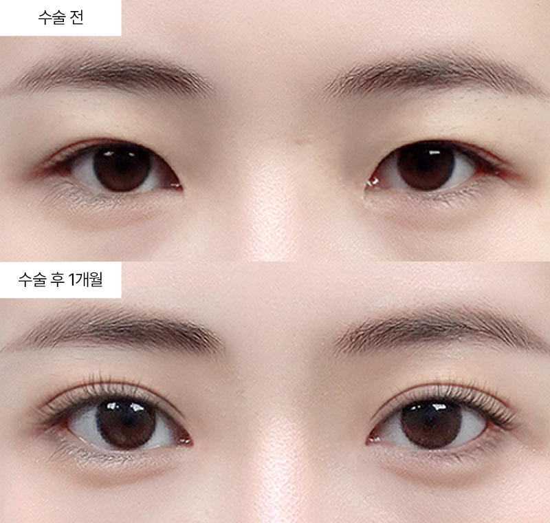 12홀 자연유착+앞트임+윗트임+뒤트임+밑트임 · 압구정 팝성형외과 전후사진