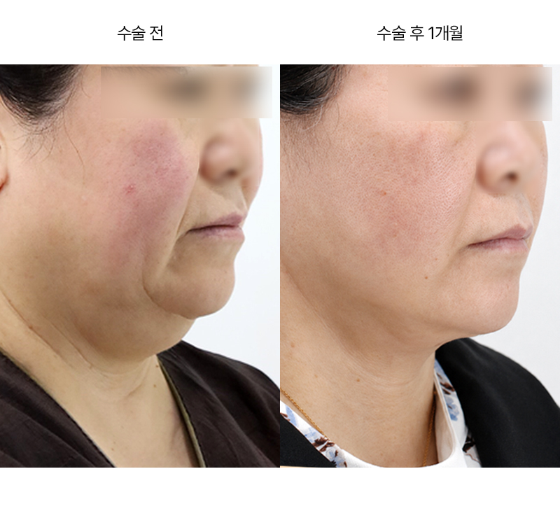 안면거상+이중턱지방흡입+근육묶기+하안검 · 압구정 팝성형외과 전후사진