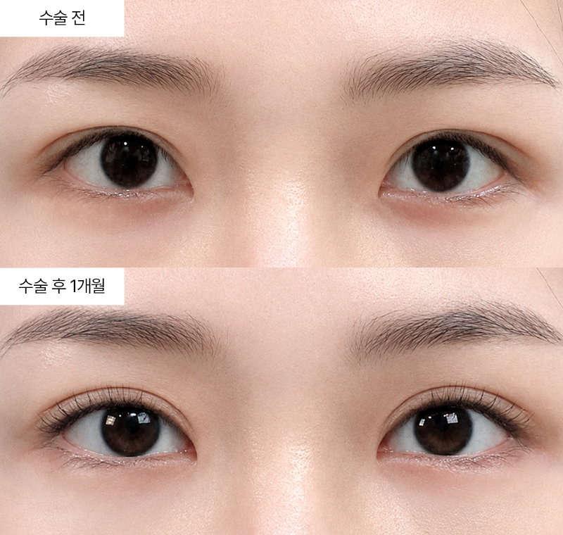 12홀 자연유착+윗트임+앞트임 · 압구정 팝성형외과 전후사진