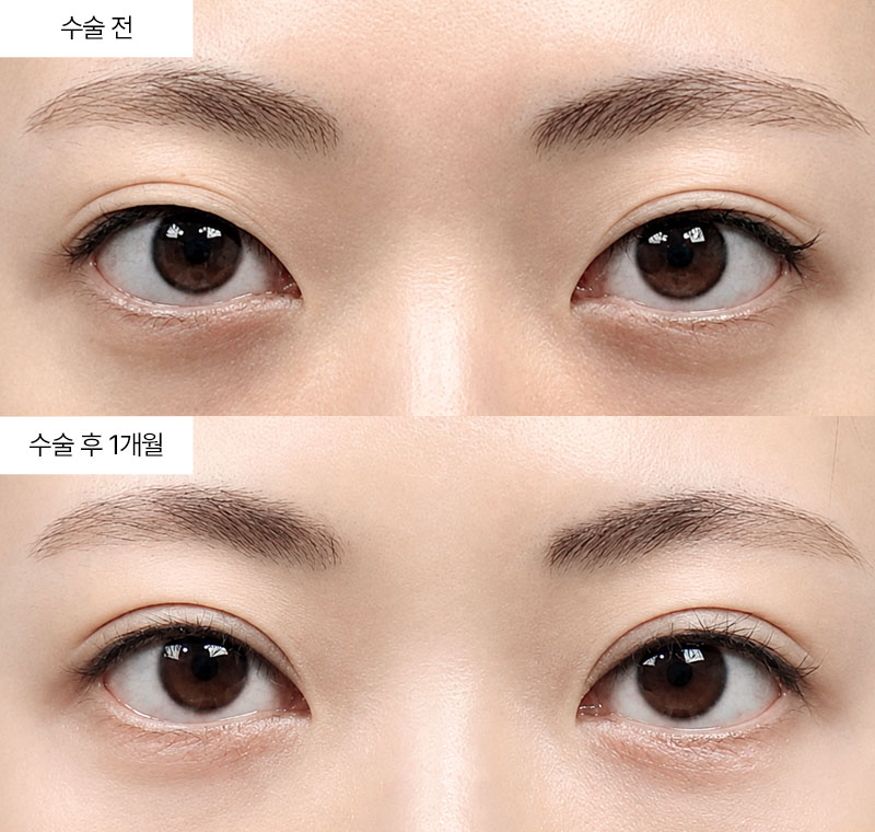 12홀 자연유착 · 압구정 팝성형외과 전후사진