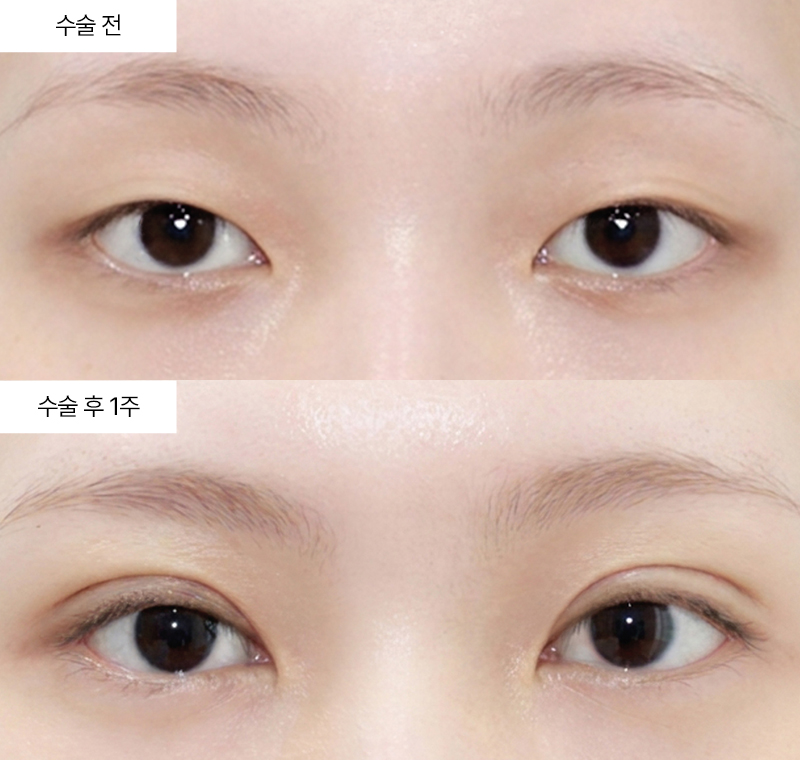 자연유착+눈매교정+앞트임+윗트임 · 압구정 팝성형외과 전후사진