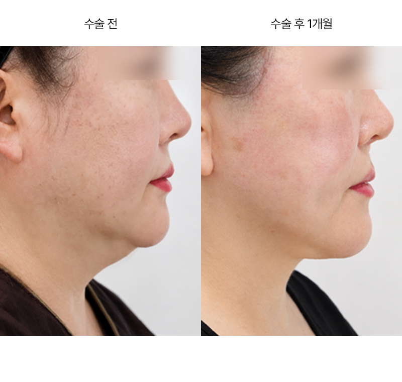 미니거상+이중턱 흡입+근육묶기 · 압구정 팝성형외과 전후사진