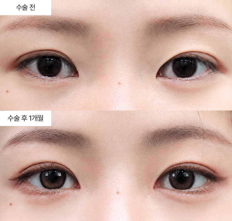 뒤트임+밑트임 · 압구정 팝성형외과 전후사진