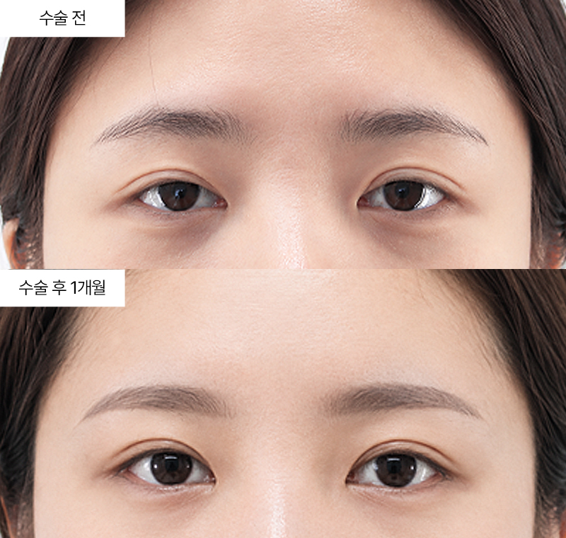 이마거상+12홀 자연유착