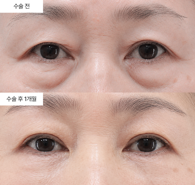 눈썹하거상+하안검+눈밑지방재배치