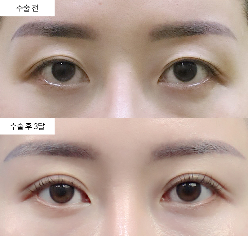 12홀 자연유착 + 눈매교정 + 윗트임