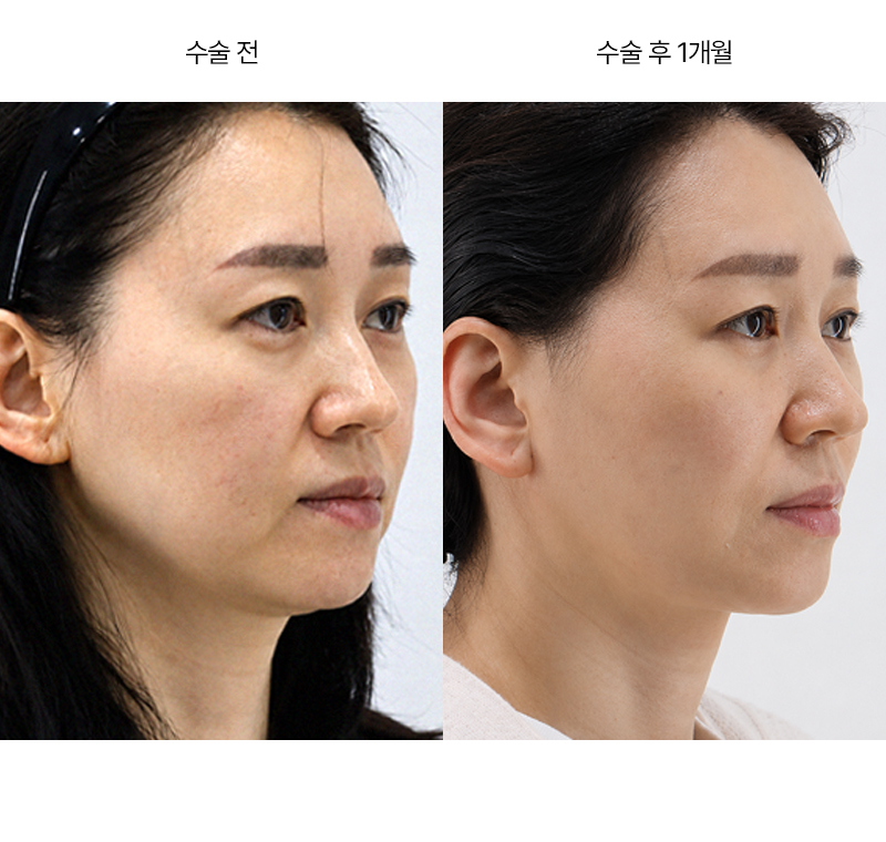 미니거상 · 압구정 팝성형외과 전후사진