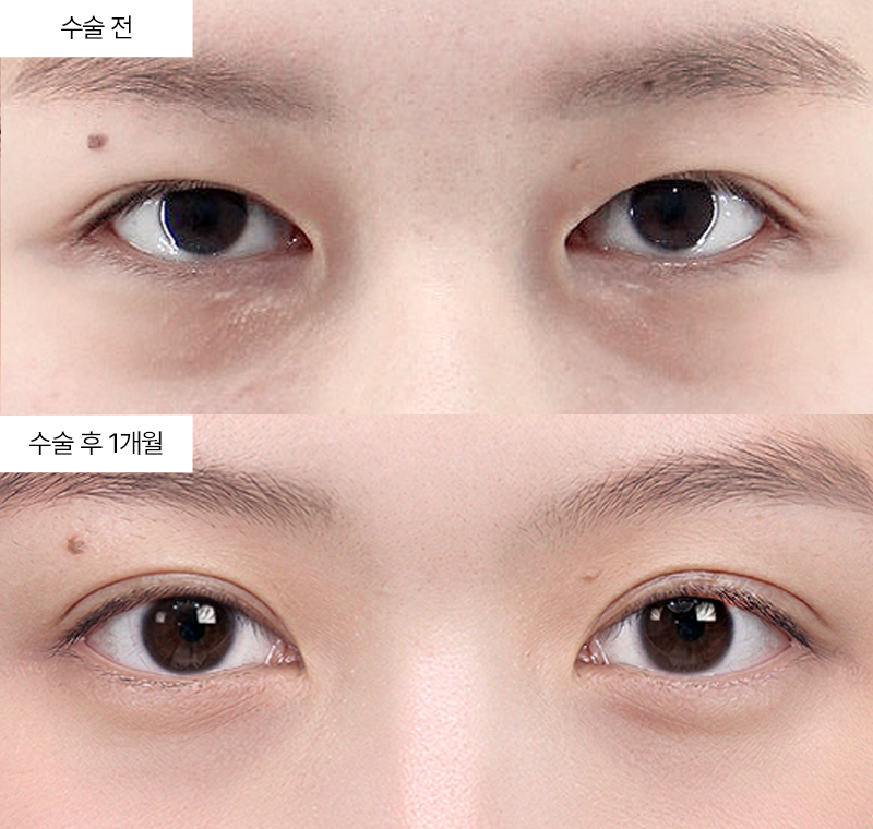 12홀 자연유착+눈매교정+눈밑지방재배치