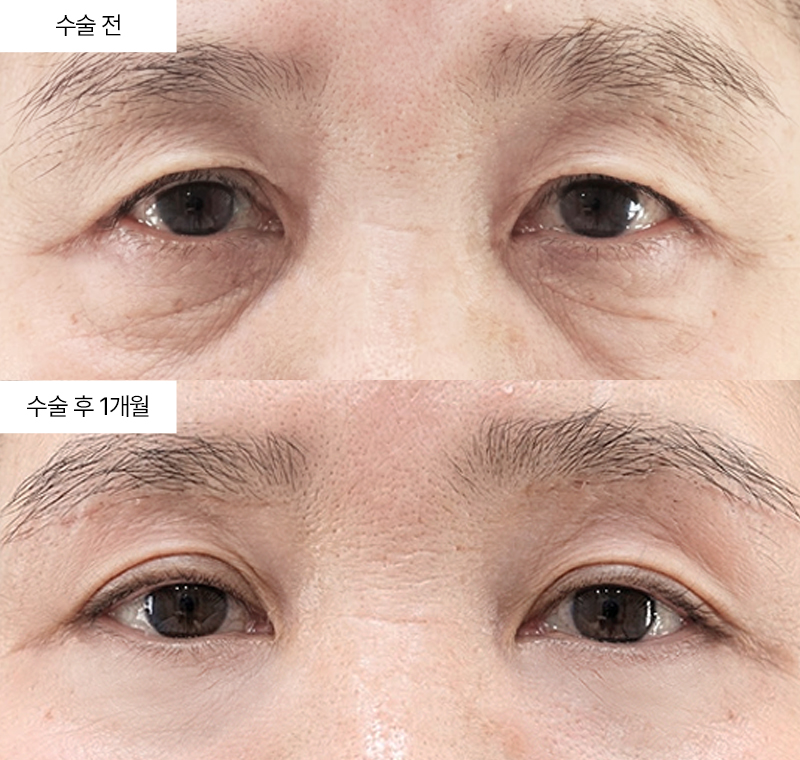 눈썹하거상+하안검