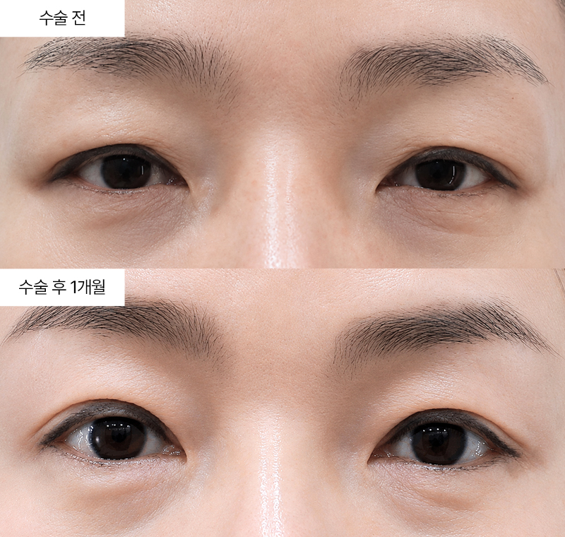 상안검+눈매교정+윗트임 · 압구정 팝성형외과 전후사진